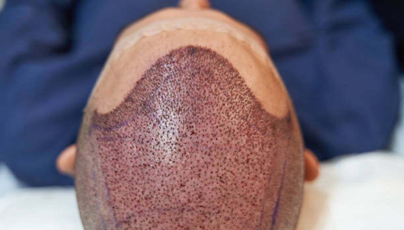  Dr. Anirudh Reddy, hair transplanet