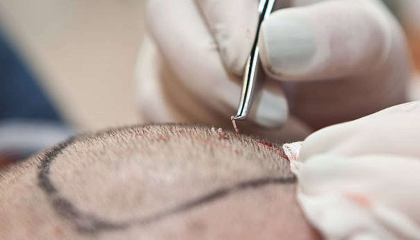  Dr. Anirudh Reddy, hair transplanet